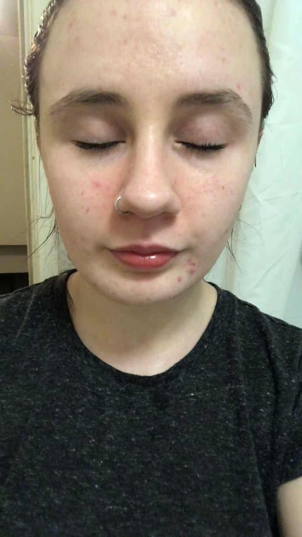 acne DE keep